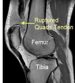 how to diagnose tendon rupture